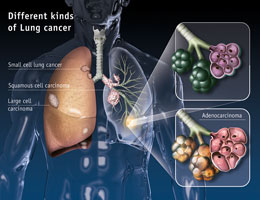 Lungenkrebs [Lung Cancer] GF1